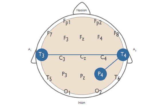 Starting placements for Infra-Low Frequency neurofeedback